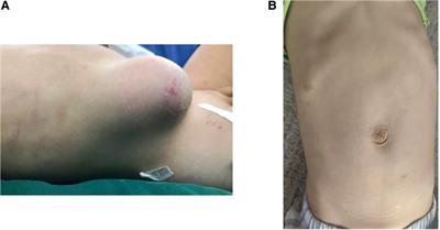 Case Report: Minimally invasive repair of a traumatic abdominal wall hernia in a child with a fascial closure device